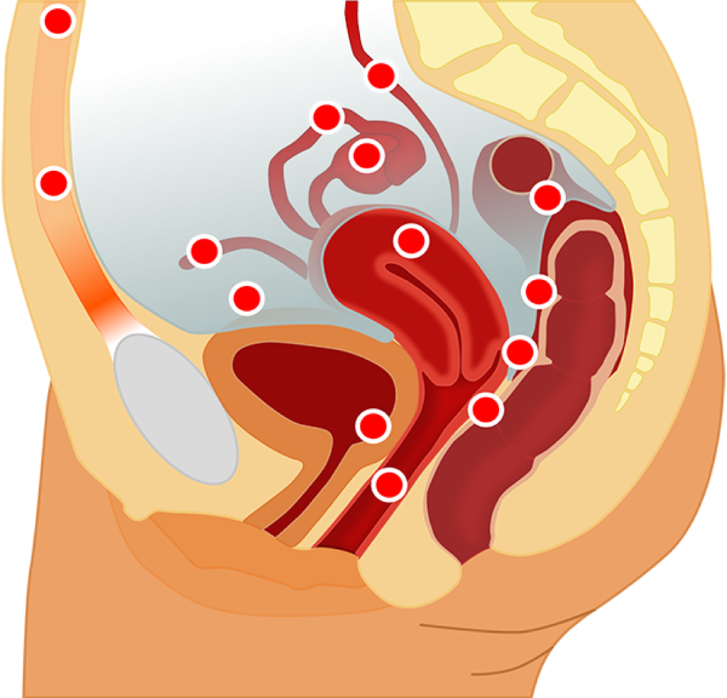 Terapia de manutenção após ooforoplastia devido endometrioma diminui  recorrência? - PEBMED