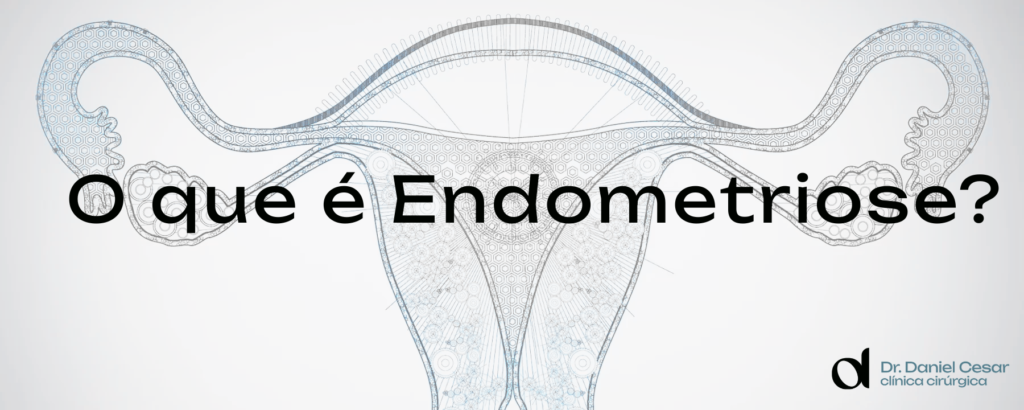 Endometriose - Daniel Cesar
